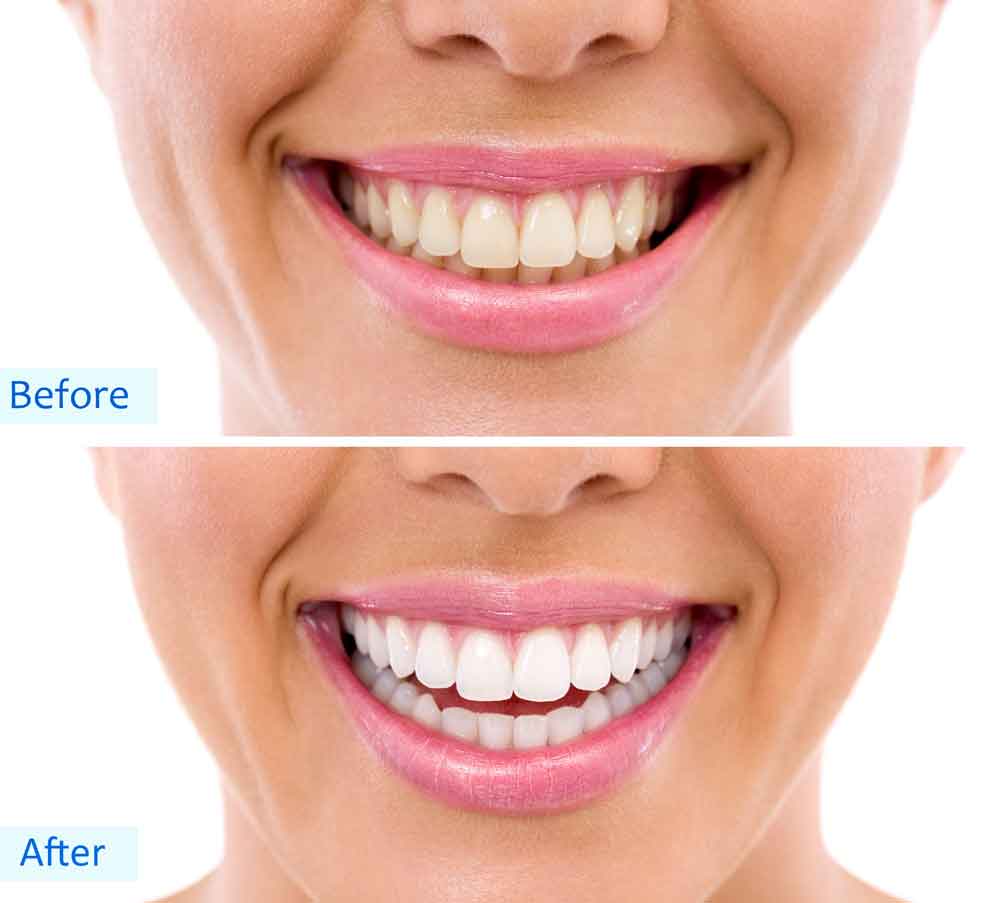 over counter teeth whitening systems